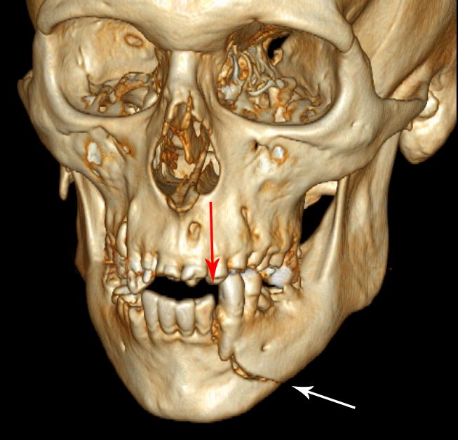 3D CT Mandible Fracture SimpleMed 3D CT Mandible Fracture SimpleMed