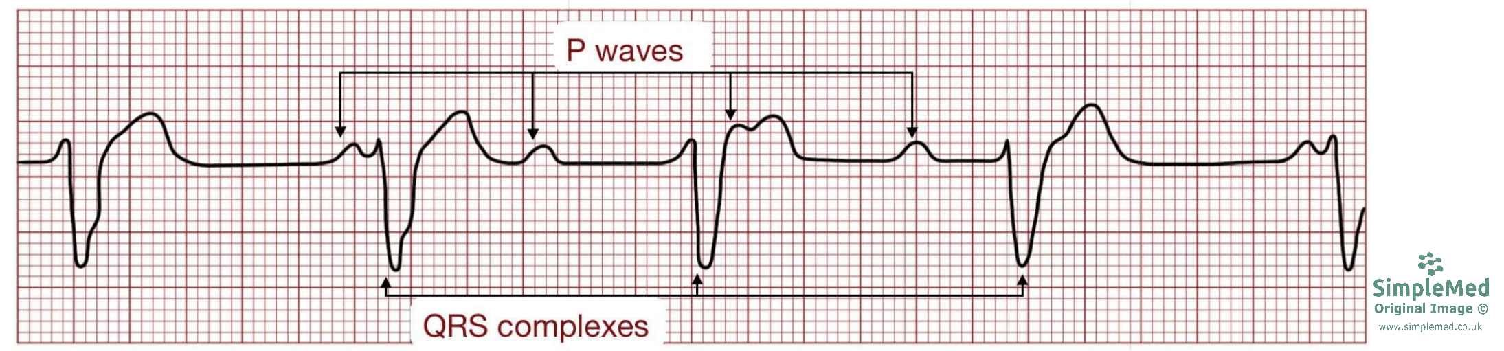 Third Degree heart block ECG SimpleMed Third Degree heart block ECG SimpleMed