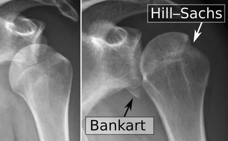 Shoulder Dislocation with Bankart lesion and Hill-sachs lesion SimpleMed Shoulder Dislocation with Bankart lesion and Hill-sachs lesion SimpleMed