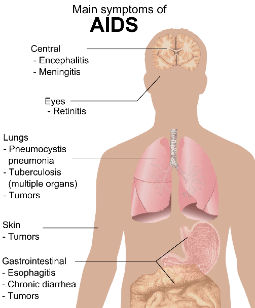 AIDS Symptoms SimpleMed AIDS Symptoms SimpleMed