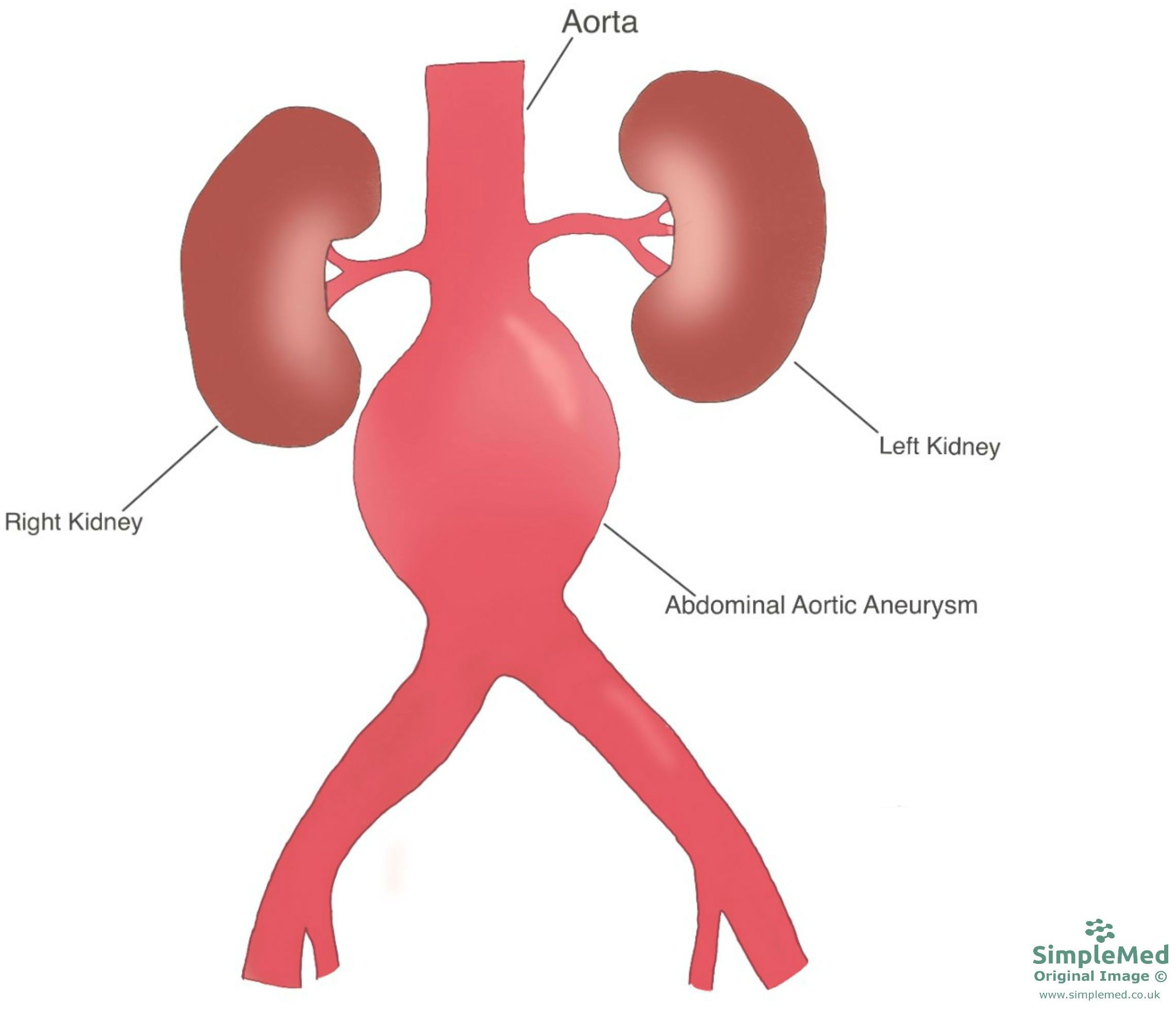 Abdominal Aortic Aneurysm Diagram SimpleMed Abdominal Aortic Aneurysm Diagram SimpleMed