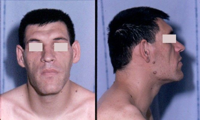 Acromegaly Facial Features SimpleMed Acromegaly Facial Features SimpleMed
