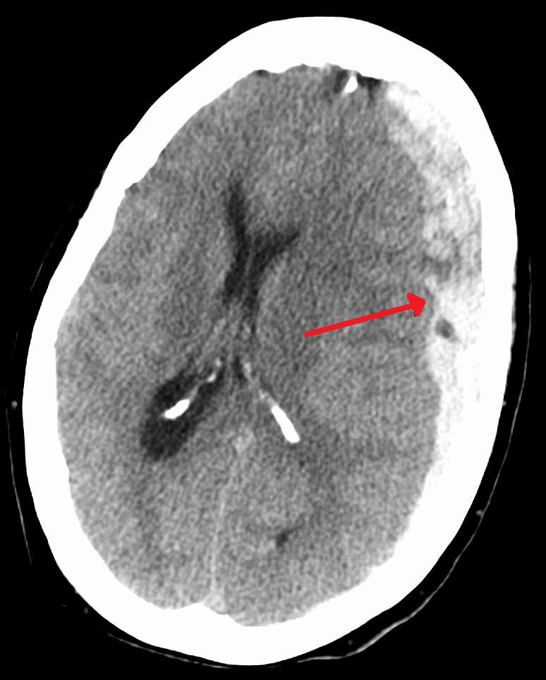 Acute Subdural Haematoma SimpleMed Acute Subdural Haematoma SimpleMed