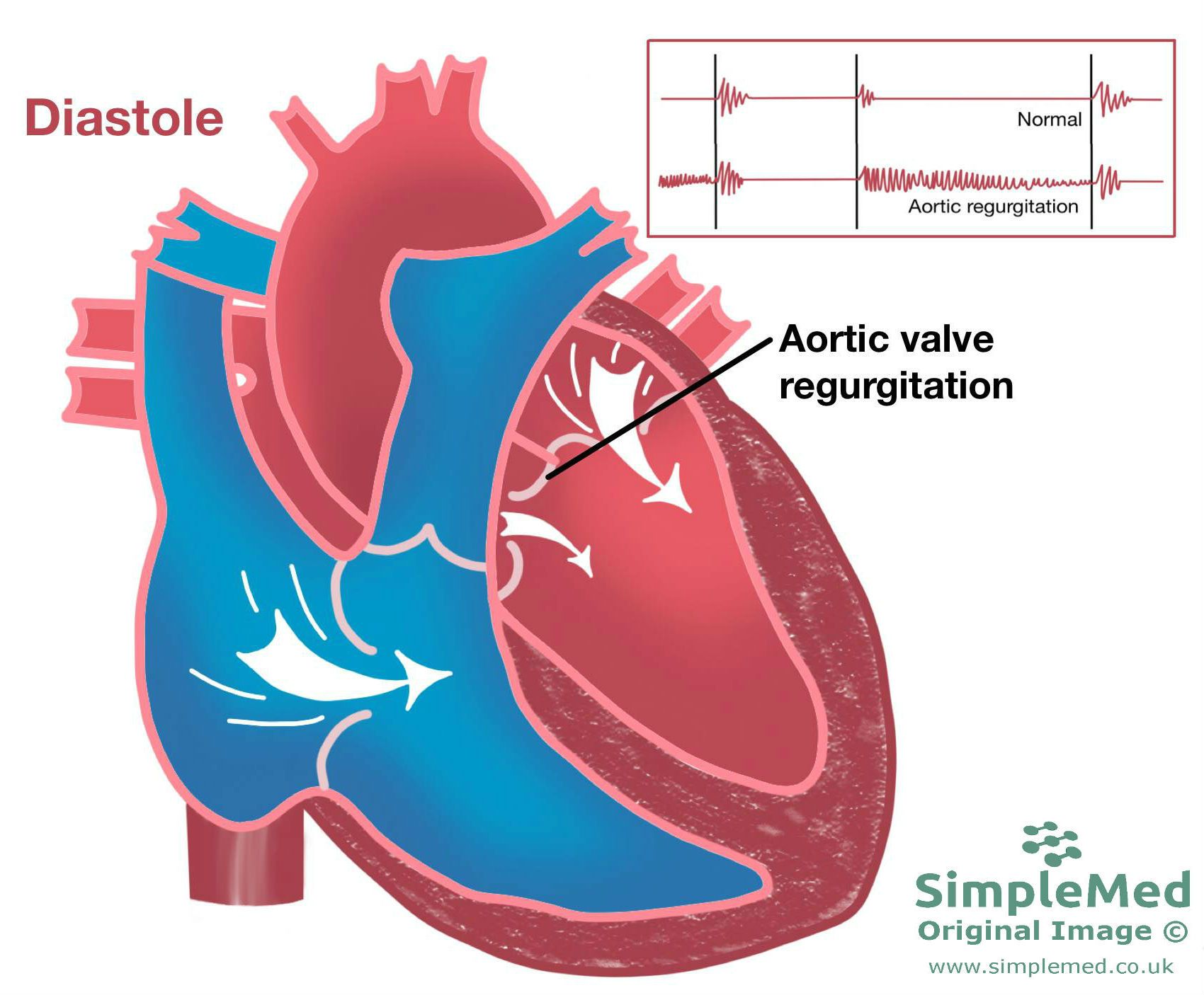 Aortic Valve Regurgitation SimpleMed Aortic Valve Regurgitation SimpleMed
