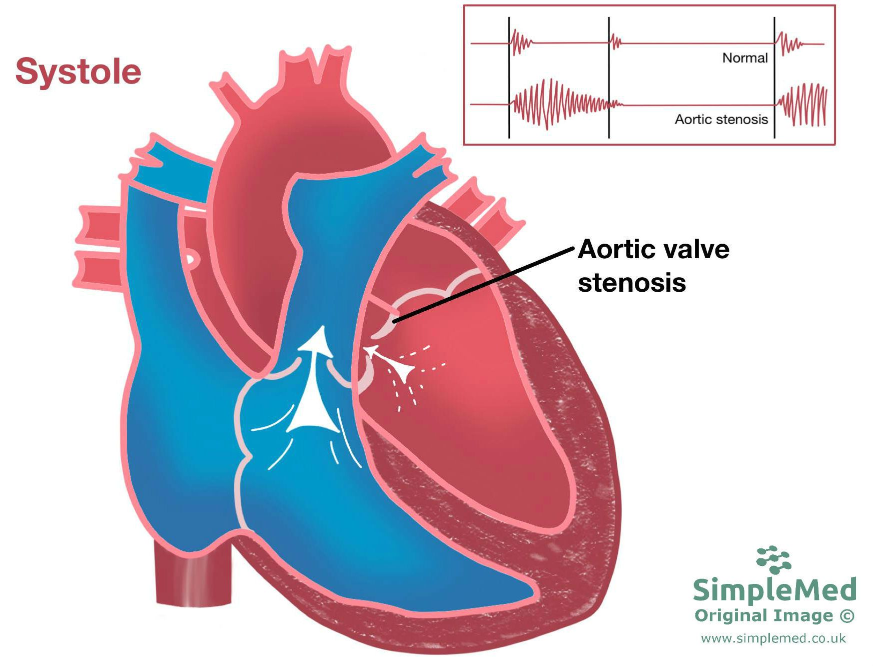 Aortic Valve Stenosis SimpleMed Aortic Valve Stenosis SimpleMed