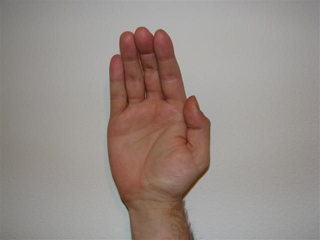 Apehand Deformity SimpleMed Apehand Deformity SimpleMed