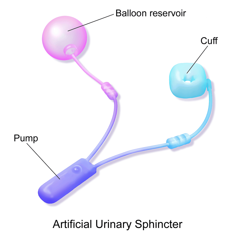 Artificial Urinary Sphincter SimpleMed Artificial Urinary Sphincter SimpleMed