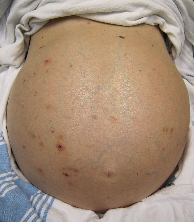 Ascites due to Hepatic Failure SimpleMed Ascites due to Hepatic Failure SimpleMed
