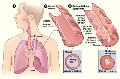 Normal Airways vs Asthmatic Airways SimpleMed Normal Airways vs Asthmatic Airways SimpleMed