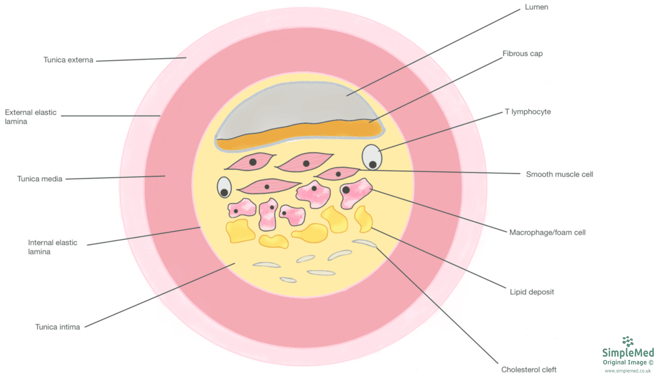 Atherosclerotic Plaque Diagram SimpleMed Atherosclerotic Plaque Diagram SimpleMed