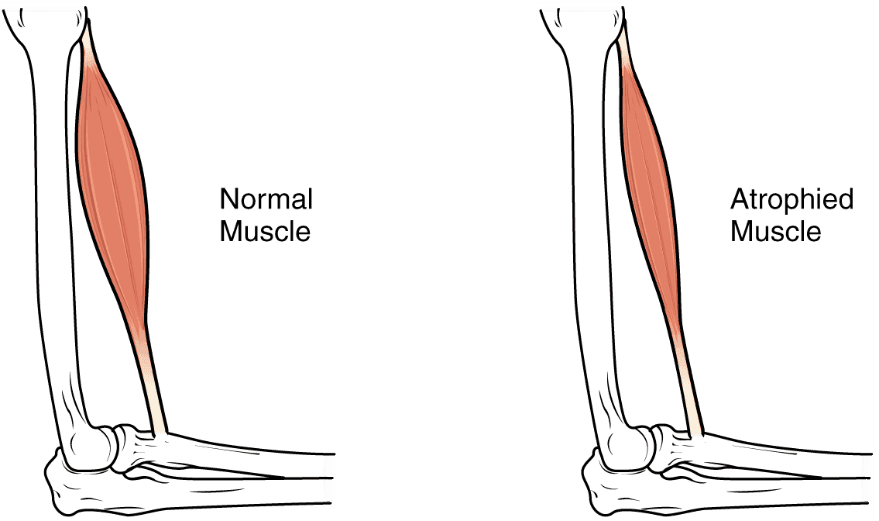 Atrophy Diagram Showing Muscle Atrophy SimpleMed Atrophy Diagram Showing Muscle Atrophy SimpleMed