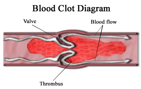 Blood Clot in a Vein SimpleMed Blood Clot in a Vein SimpleMed