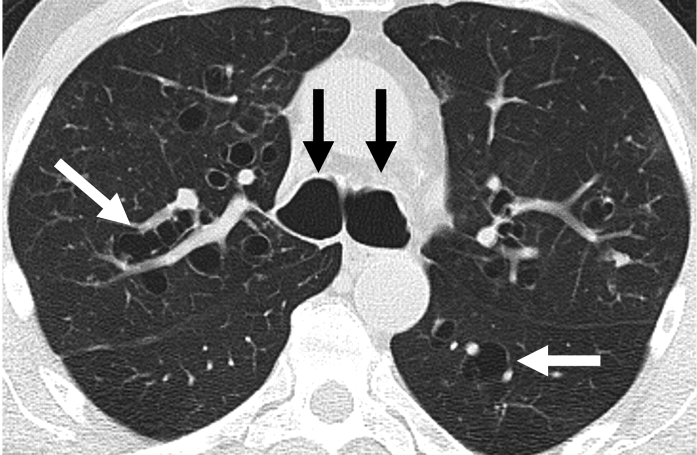 Bronchiectasis CT Scan SimpleMed Bronchiectasis CT Scan SimpleMed