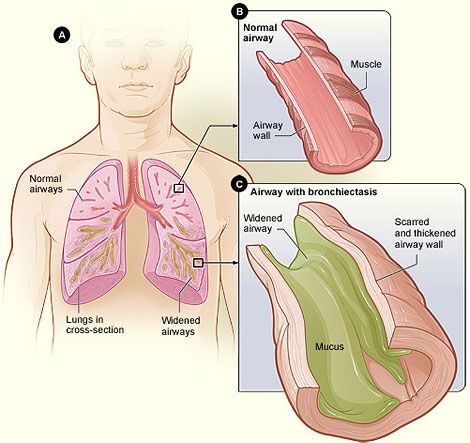 Bronchiectasis vs Normal Lung SimpleMed Bronchiectasis vs Normal Lung SimpleMed