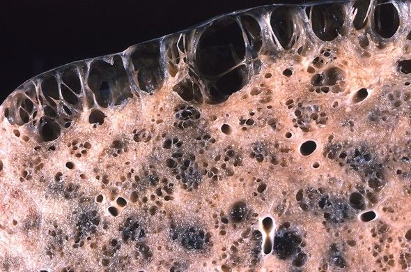 Bullae in Emphysema SimpleMed Bullae in Emphysema SimpleMed