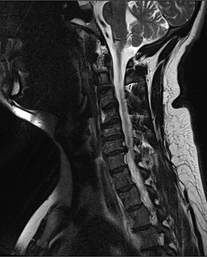 C6-C7 Disc Herniation SimpleMed C6-C7 Disc Herniation SimpleMed