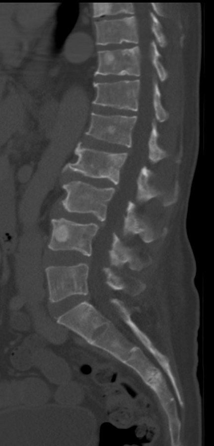 Osteoblastic Lesions SimpleMed Osteoblastic Lesions SimpleMed