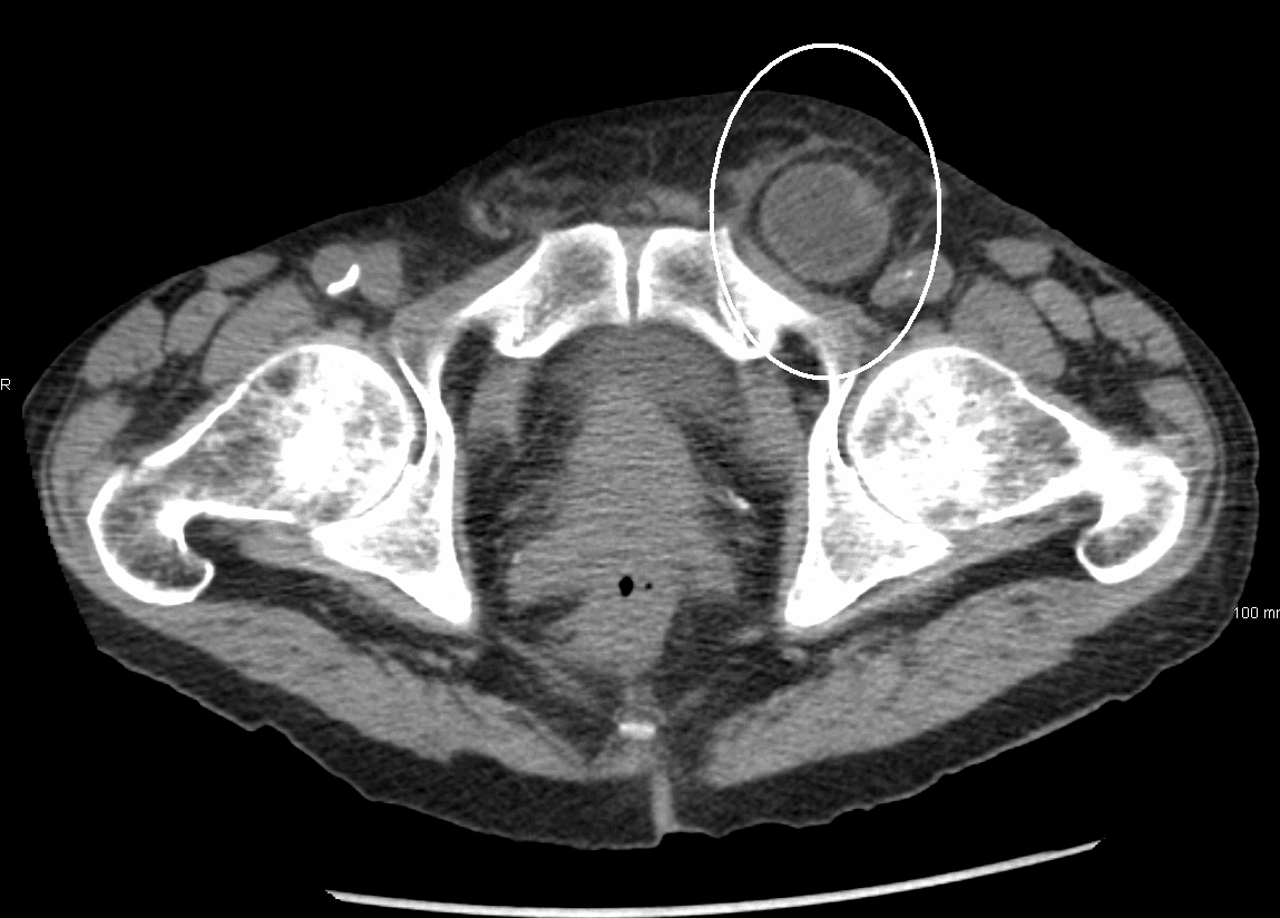 CT Scan of an Inguinal Hernia SimpleMed CT Scan of an Inguinal Hernia SimpleMed
