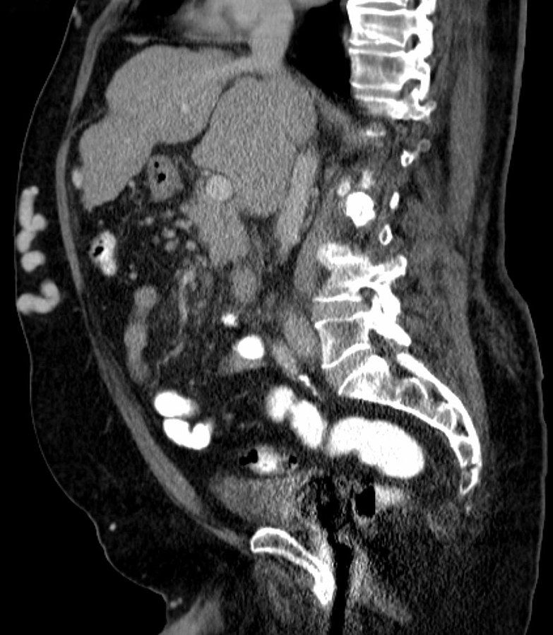 Caput Medusa on CT Scan SimpleMed Caput Medusa on CT Scan SimpleMed