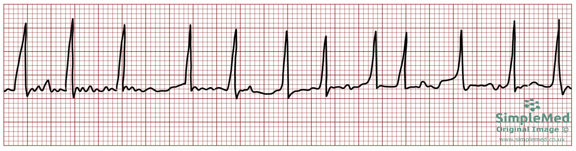Atrial Fibrillation Electrocardiogram ECG SimpleMed Atrial Fibrillation Electrocardiogram ECG SimpleMed