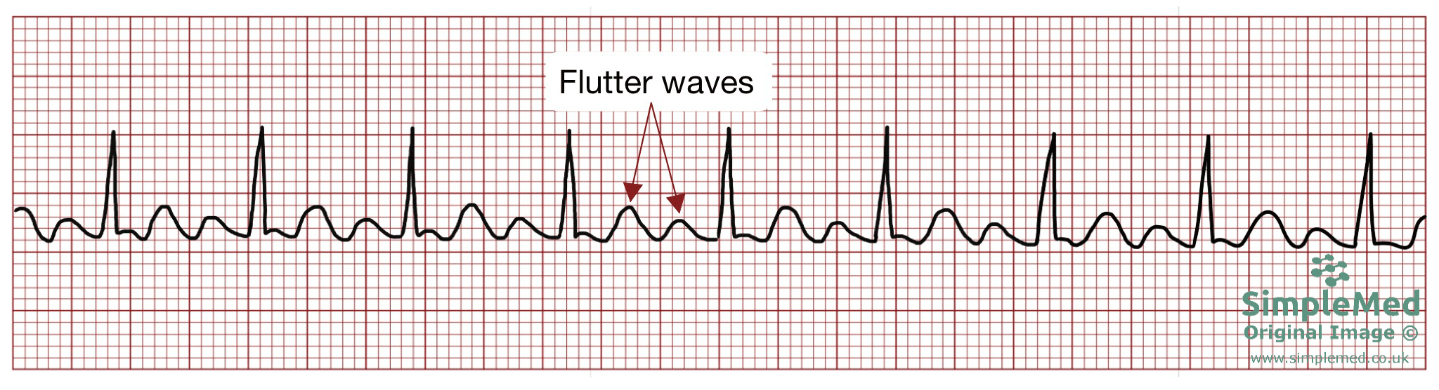 Atrial Flutter ECG electrocardiogram pathology SimpleMed Atrial Flutter ECG electrocardiogram pathology SimpleMed