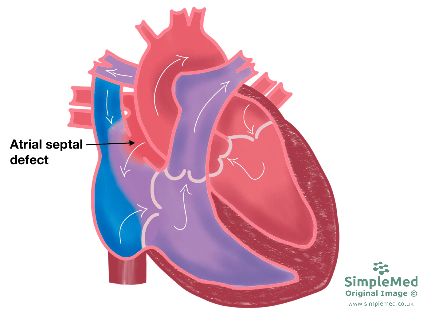 Atrial Septal Defect SimpleMed Atrial Septal Defect SimpleMed