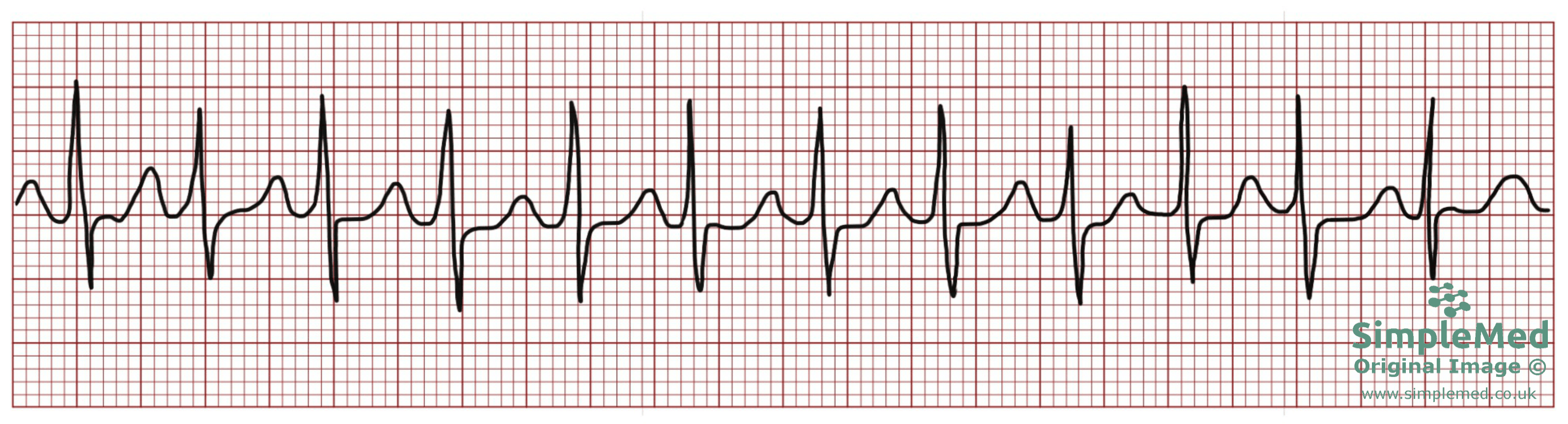 Atrial Tachycardia ECG electrocardiogram pathology SimpleMed Atrial Tachycardia ECG electrocardiogram pathology SimpleMed