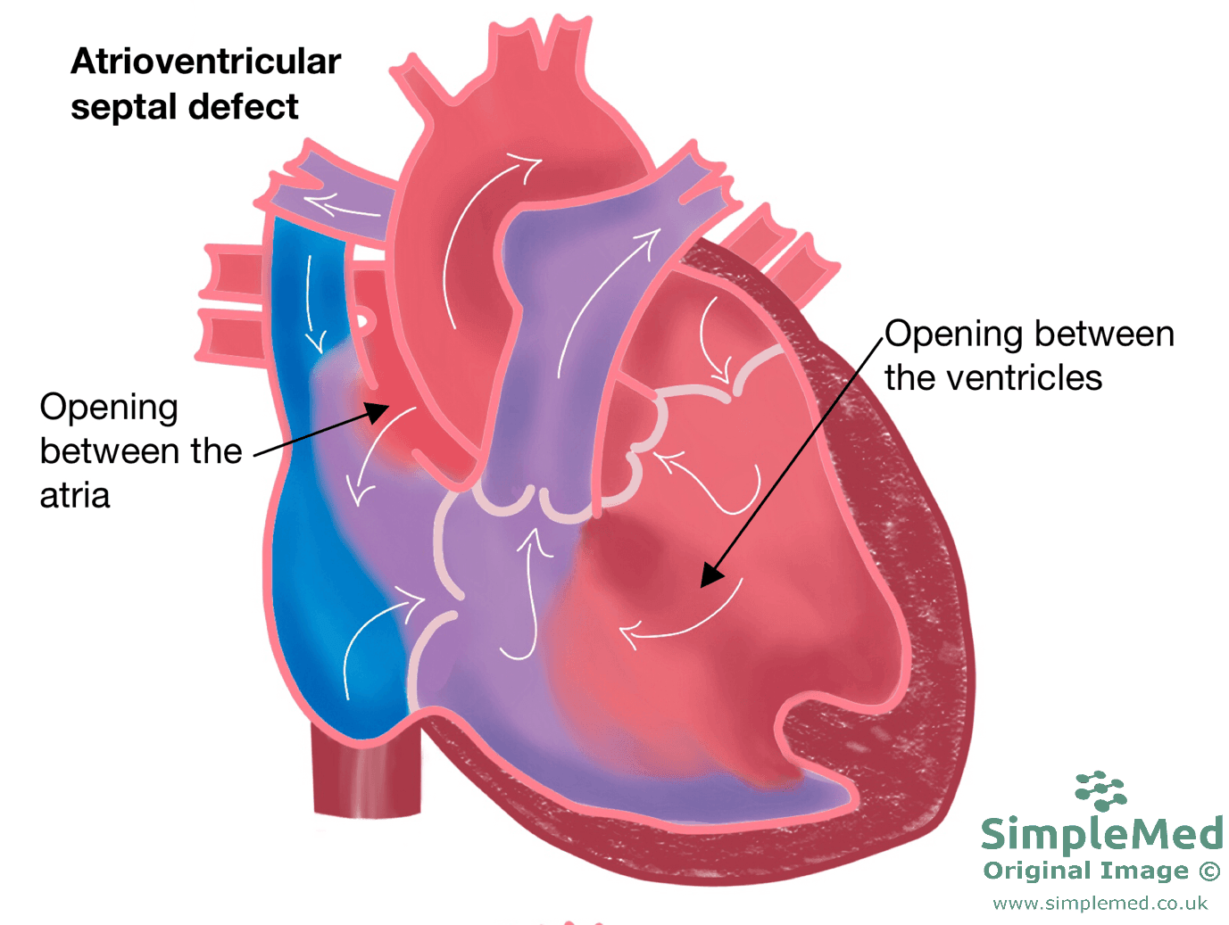 Atrioventricular Septal Heart Defect SimpleMed Atrioventricular Septal Heart Defect SimpleMed
