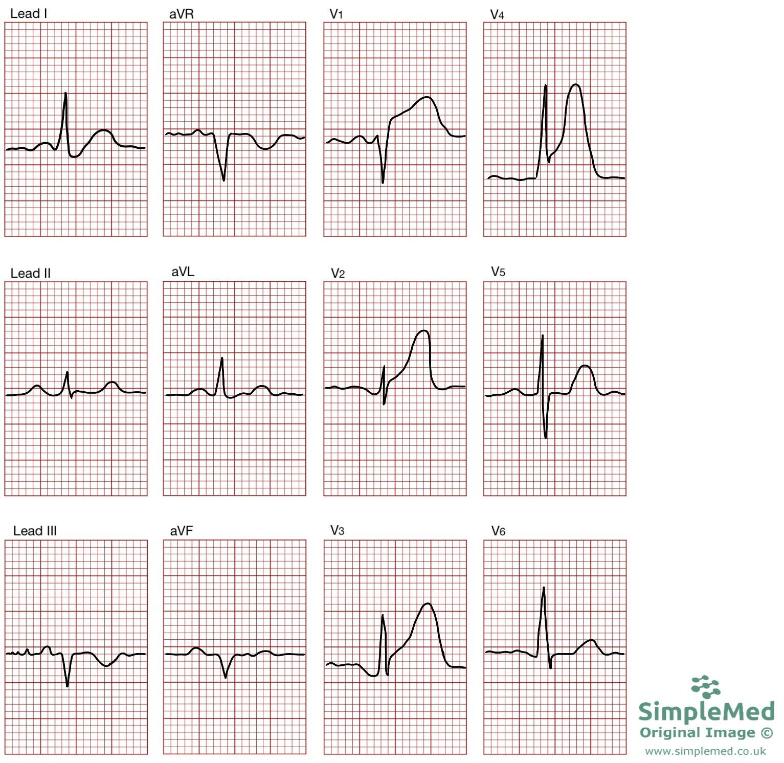 12 Lead ECG of a STEMI SimpleMed 12 Lead ECG of a STEMI SimpleMed