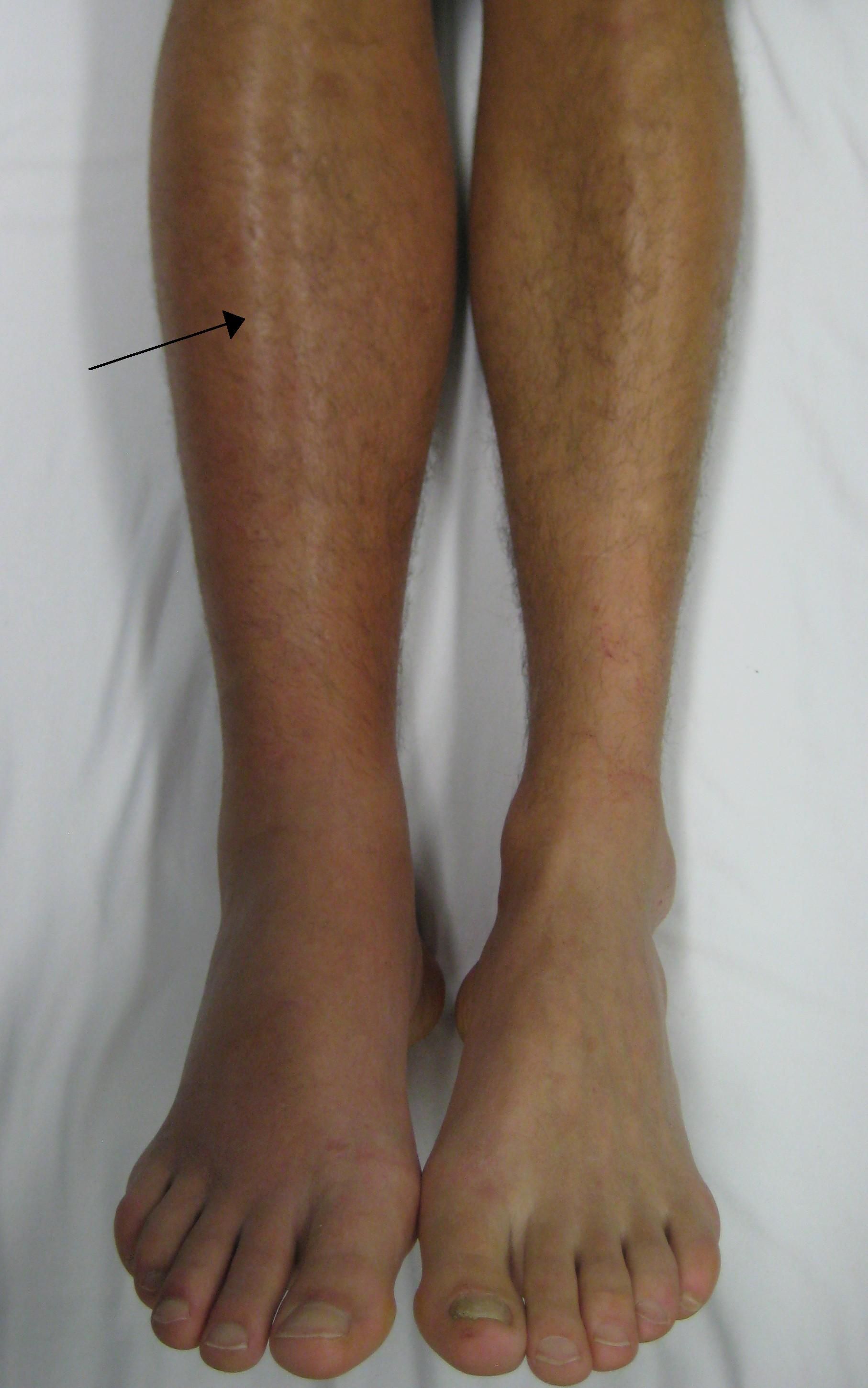 Deep Vein Thrombosis SimpleMed Deep Vein Thrombosis SimpleMed