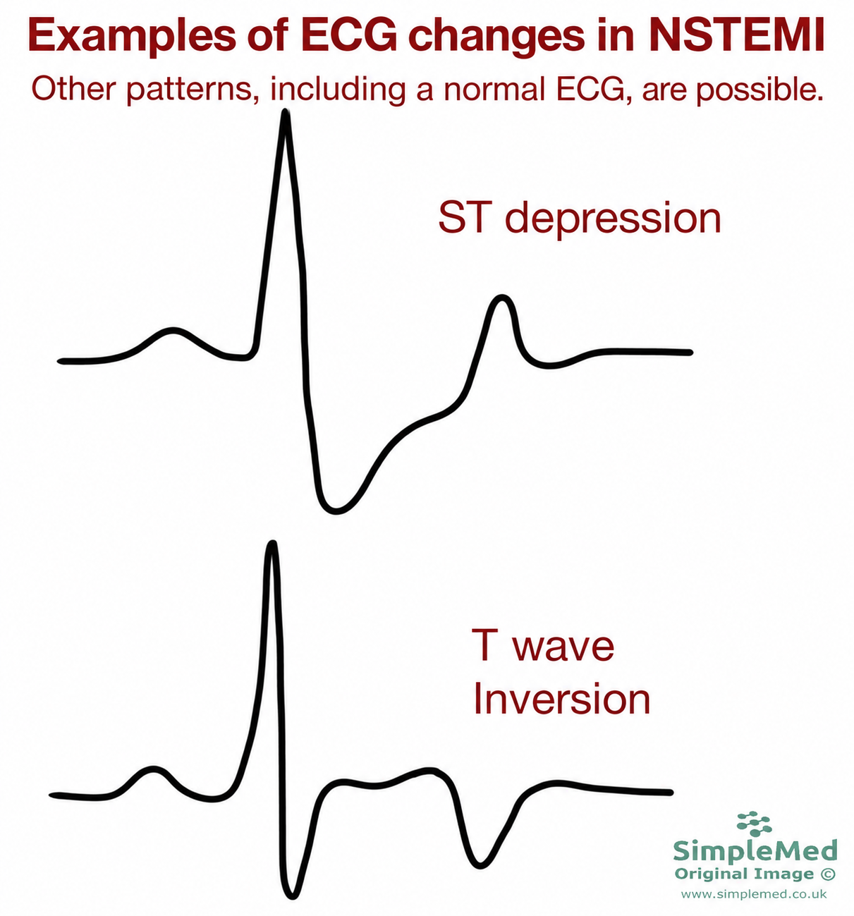 Examples of ECG changes in NSTEMI Two illustrative ECG tracings showing ST depression and T wave inversion in NSTEMI; other patterns, including a normal ECG, are possible.