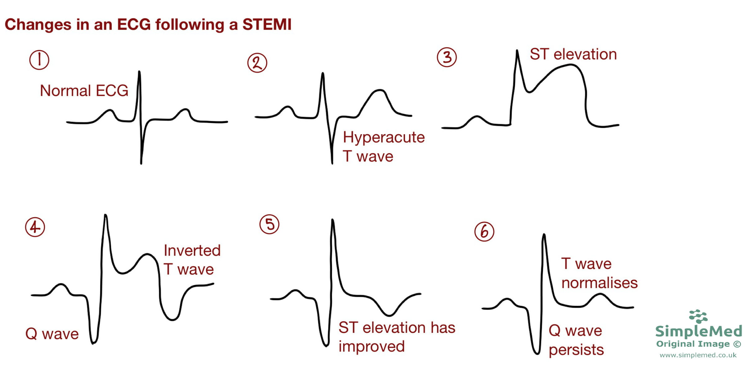 ECG changes in a STEMI SimpleMed ECG changes in a STEMI SimpleMed