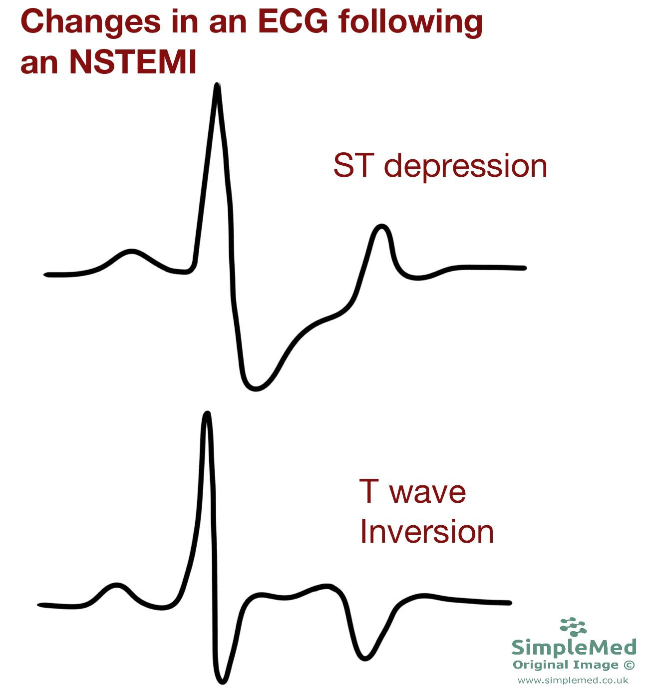 ECG changes in an NSTEMI SimpleMed ECG changes in an NSTEMI SimpleMed