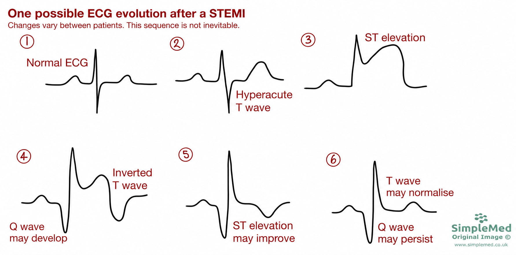 One possible ECG evolution after a STEMI Six illustrative ECG panels: normal tracing, hyperacute T wave, ST elevation, possible Q wave and T inversion, improving ST elevation, and possible T normalisation with a persisting Q wave. This sequence is not inevitable.