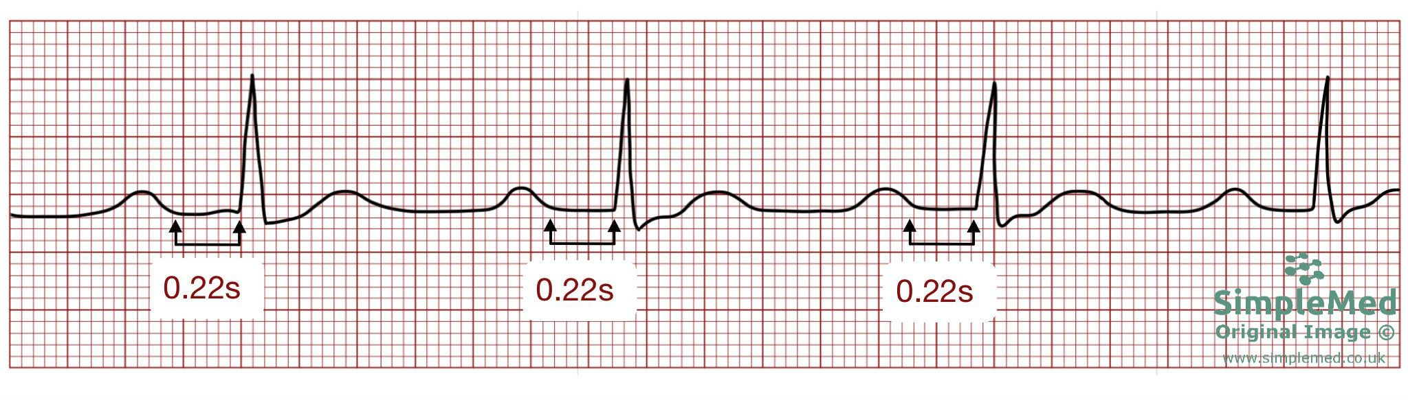 First degree heart block ECG SimpleMed First degree heart block ECG SimpleMed