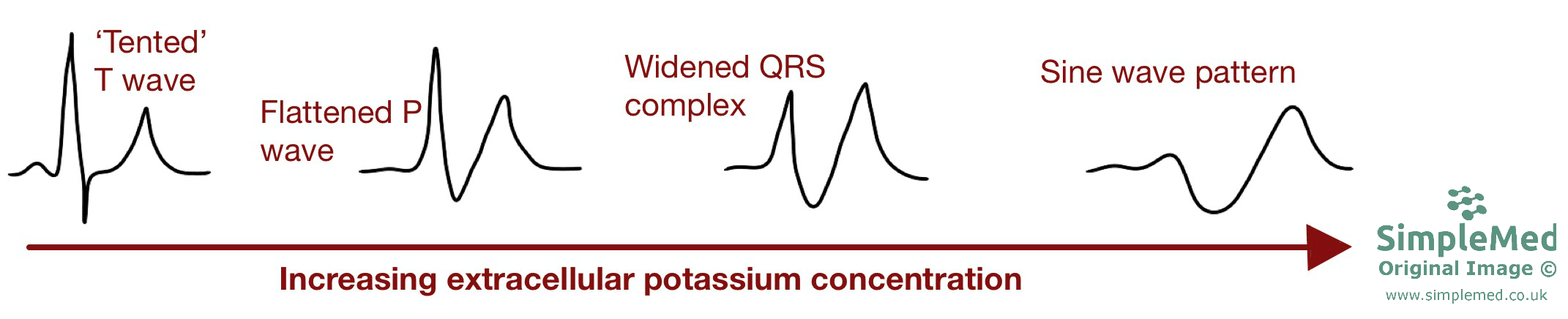 Hyperkalaemia ECG changes SimpleMed Hyperkalaemia ECG changes SimpleMed