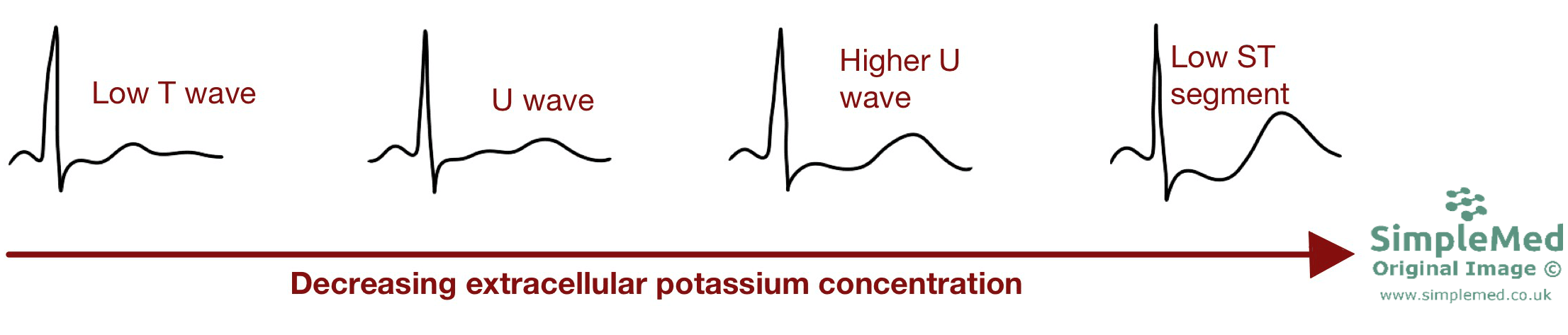 Hypokalaemia ECG changes SimpleMed Hypokalaemia ECG changes SimpleMed