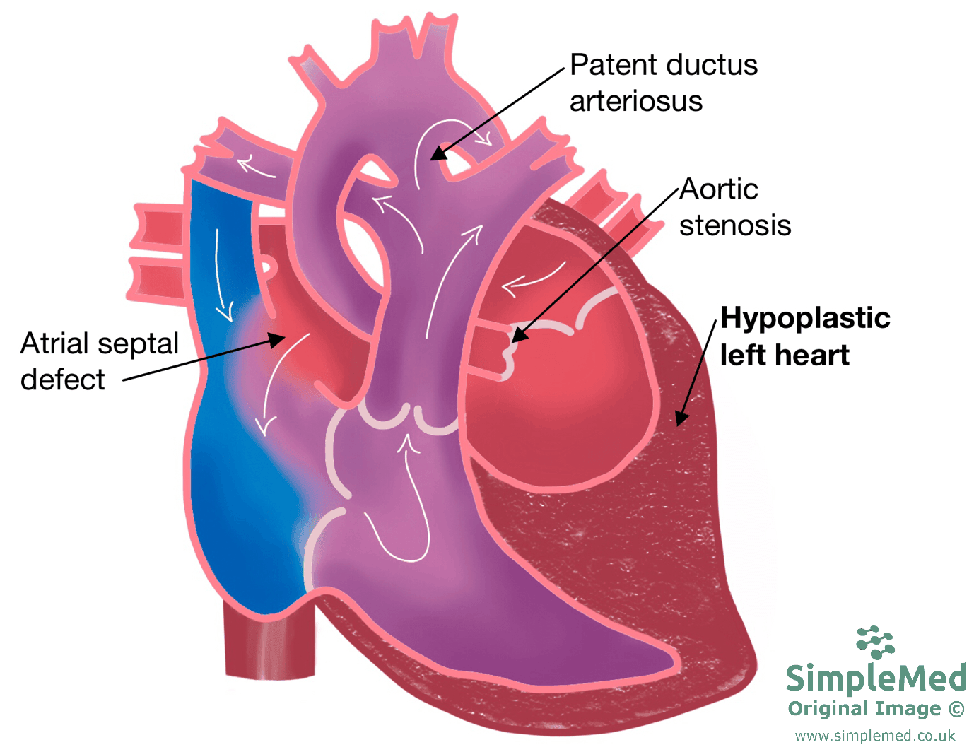 Hypoplastic Left Heart SimpleMed Hypoplastic Left Heart SimpleMed