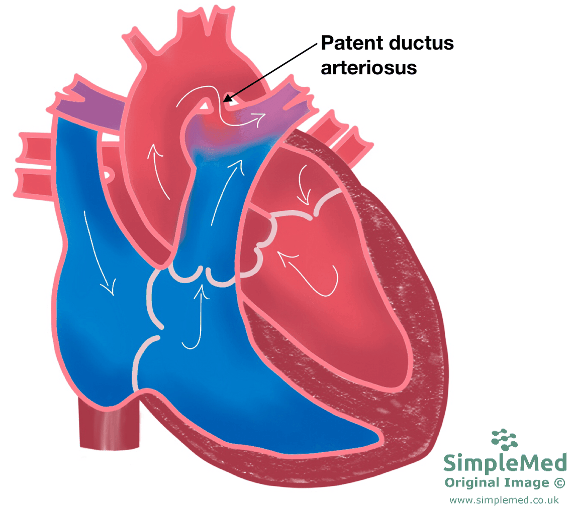 Patent Ductus Arteriosus SimpleMed Patent Ductus Arteriosus SimpleMed