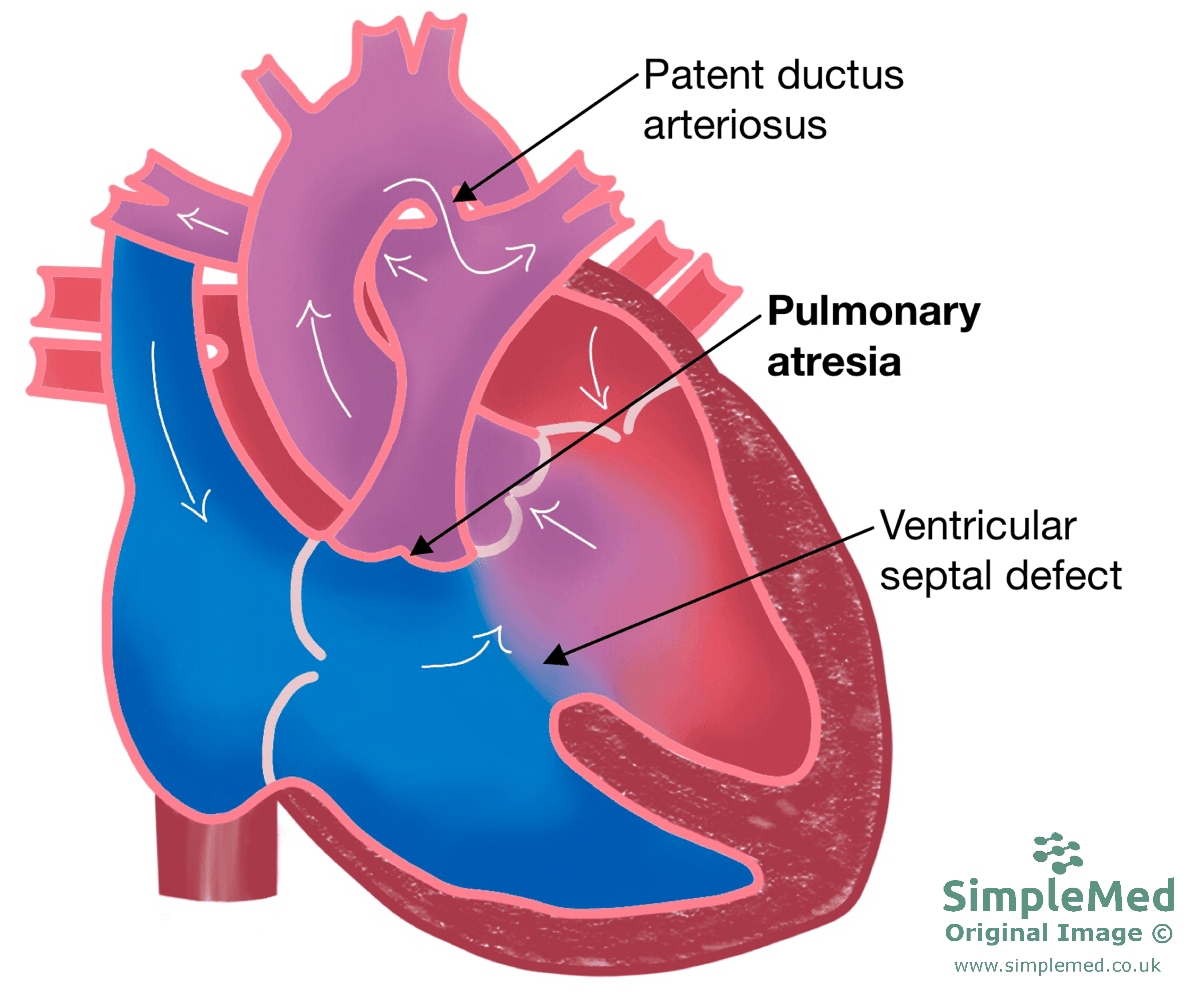 Pulmonary Atresia with Ventricular Septal Defect SimpleMed Pulmonary Atresia with Ventricular Septal Defect SimpleMed