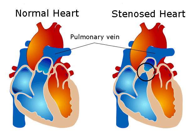Pulmonary Valve Stenosis SimpleMed Pulmonary Valve Stenosis SimpleMed