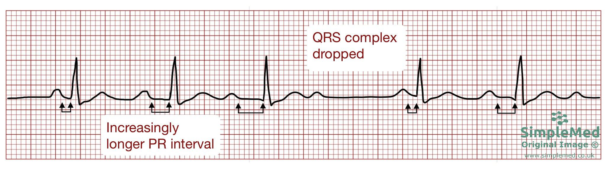 Second degree heart block Mobitz type 1 ECG SimpleMed Second degree heart block Mobitz type 1 ECG SimpleMed