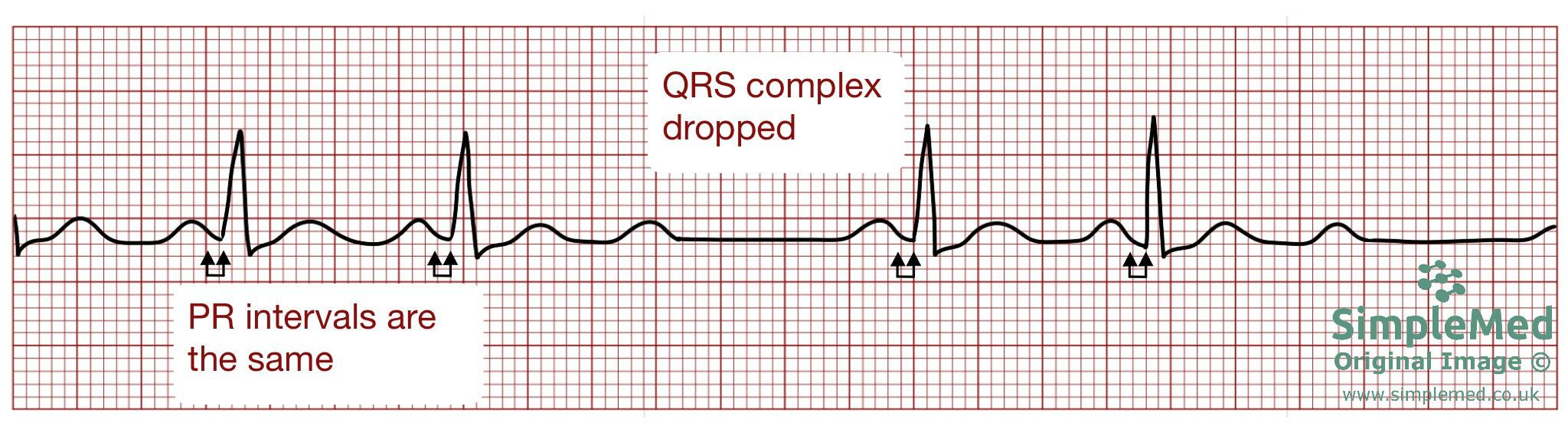 Second degree Mobitz Type 2 ECG SimpleMed Second degree Mobitz Type 2 ECG SimpleMed