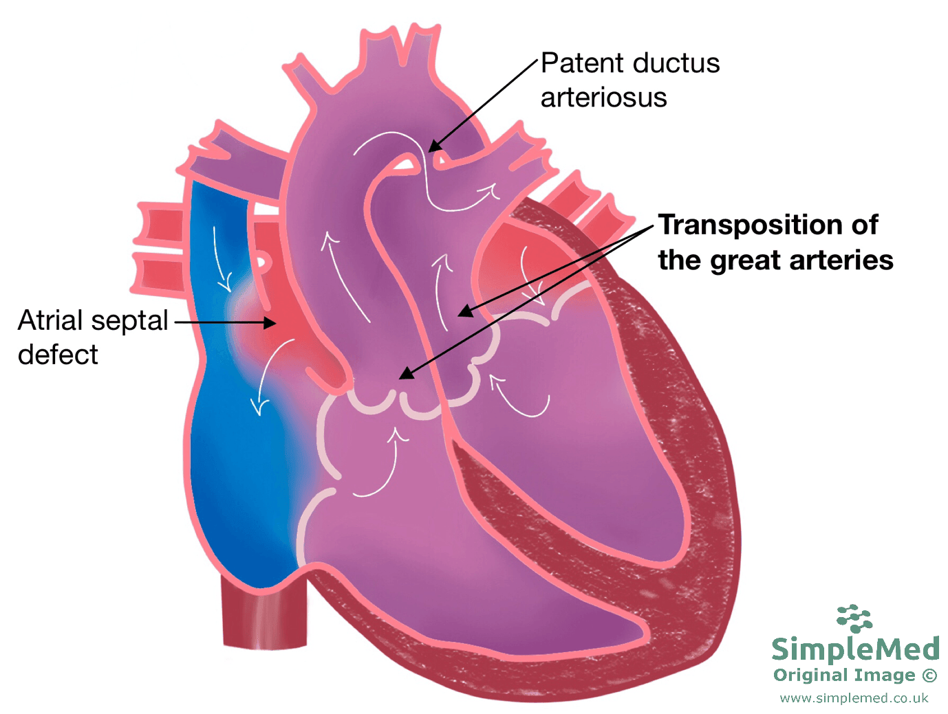 Transposition of the Great Arteries SimpleMed Transposition of the Great Arteries SimpleMed