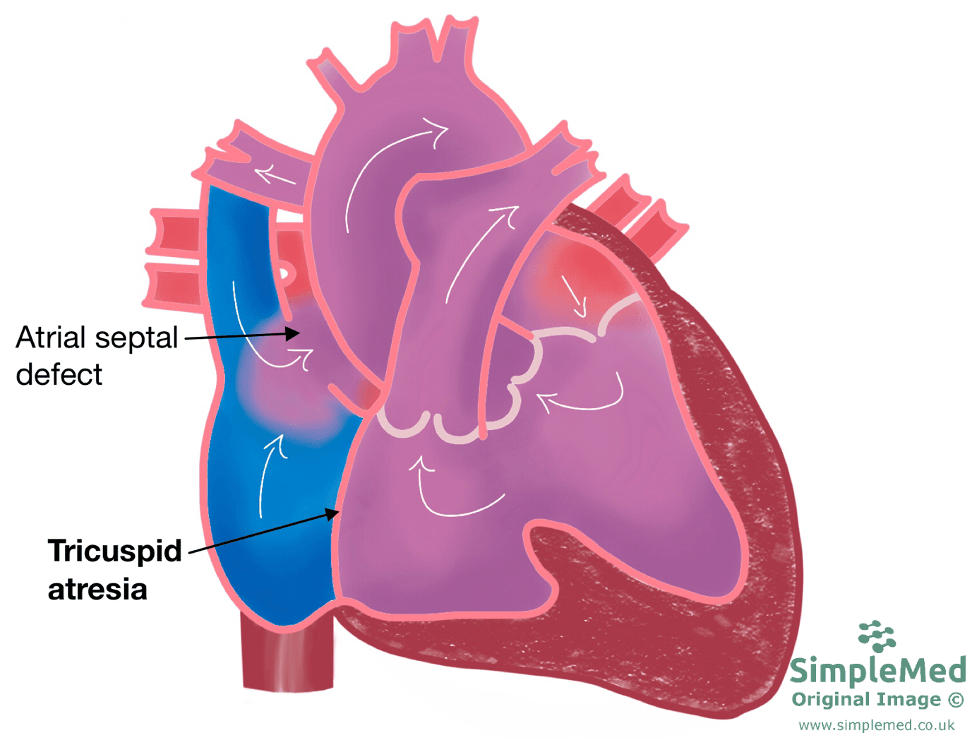 Tricuspid Atresia SimpleMed Tricuspid Atresia SimpleMed