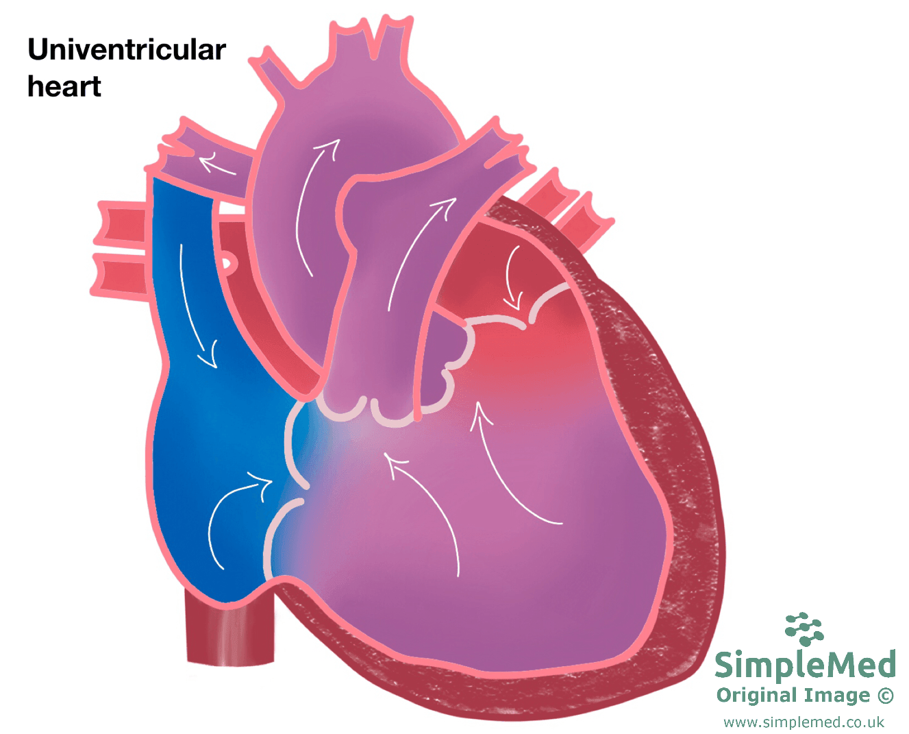 Univentricular Left Heart SimpleMed Univentricular Left Heart SimpleMed