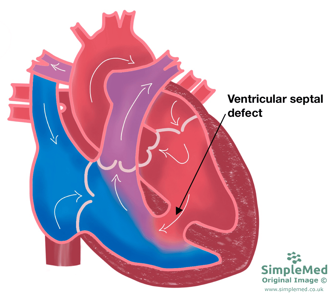 Ventricular Septal Defect SimpleMed Ventricular Septal Defect SimpleMed