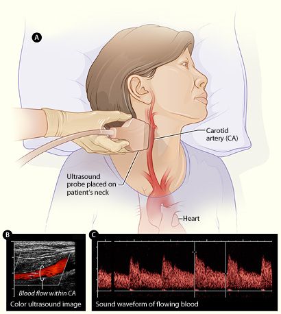 Carotid Doppler Ultrasound Scan SimpleMed Carotid Doppler Ultrasound Scan SimpleMed