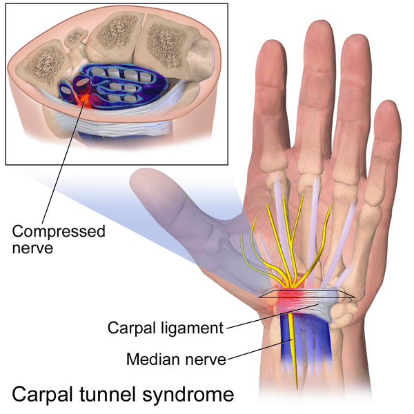 Carpal Tunnel Syndrome SimpleMed Carpal Tunnel Syndrome SimpleMed