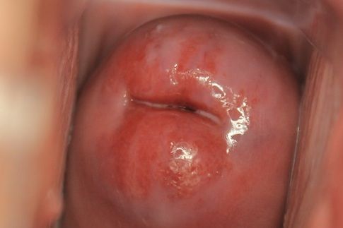 Cervical Ectropion SimpleMed Cervical Ectropion SimpleMed